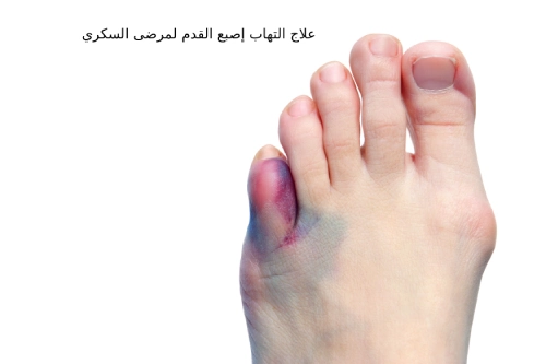 علاج التهاب إصبع القدم لمرضى السكري